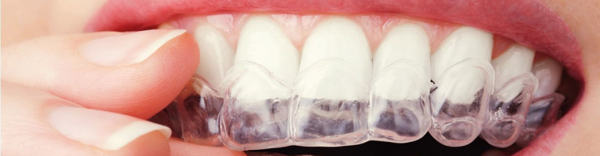 dental braces and orthodontics - Smile Dental Group Crewkerne