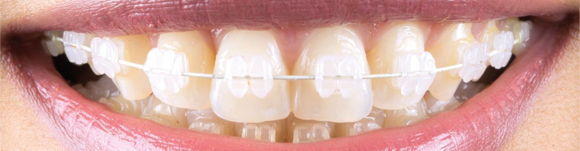 dental braces and orthodontics - Smile Dental Group Ilminster