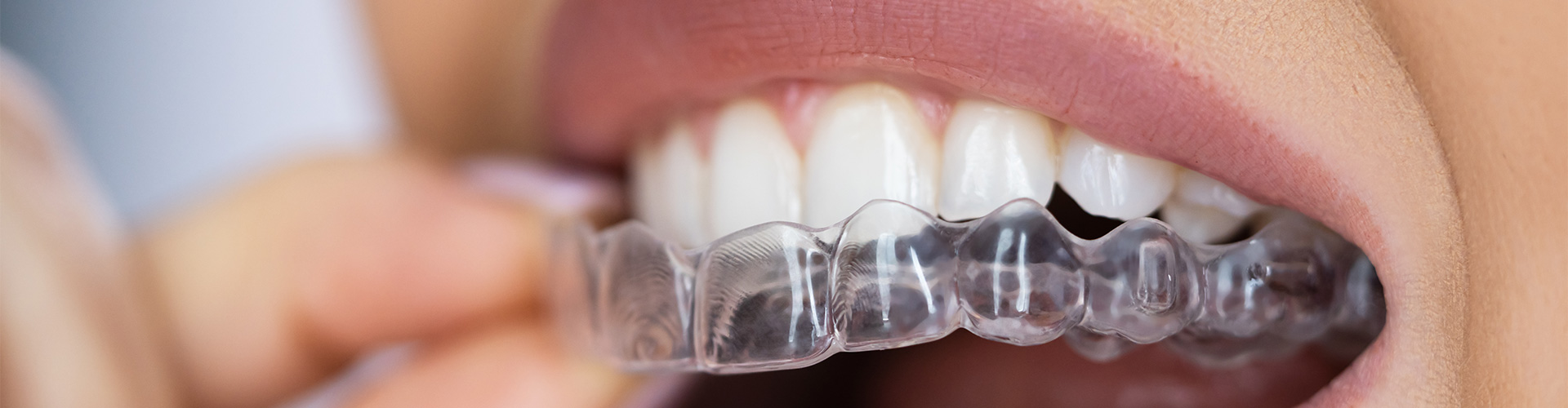 dental braces and orthodontics - Smile Dental Group Ilminster